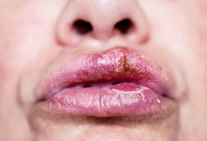 Ağız yarasına ne iyi gelir? Ağız yarası nasıl geçer? Neden olur?